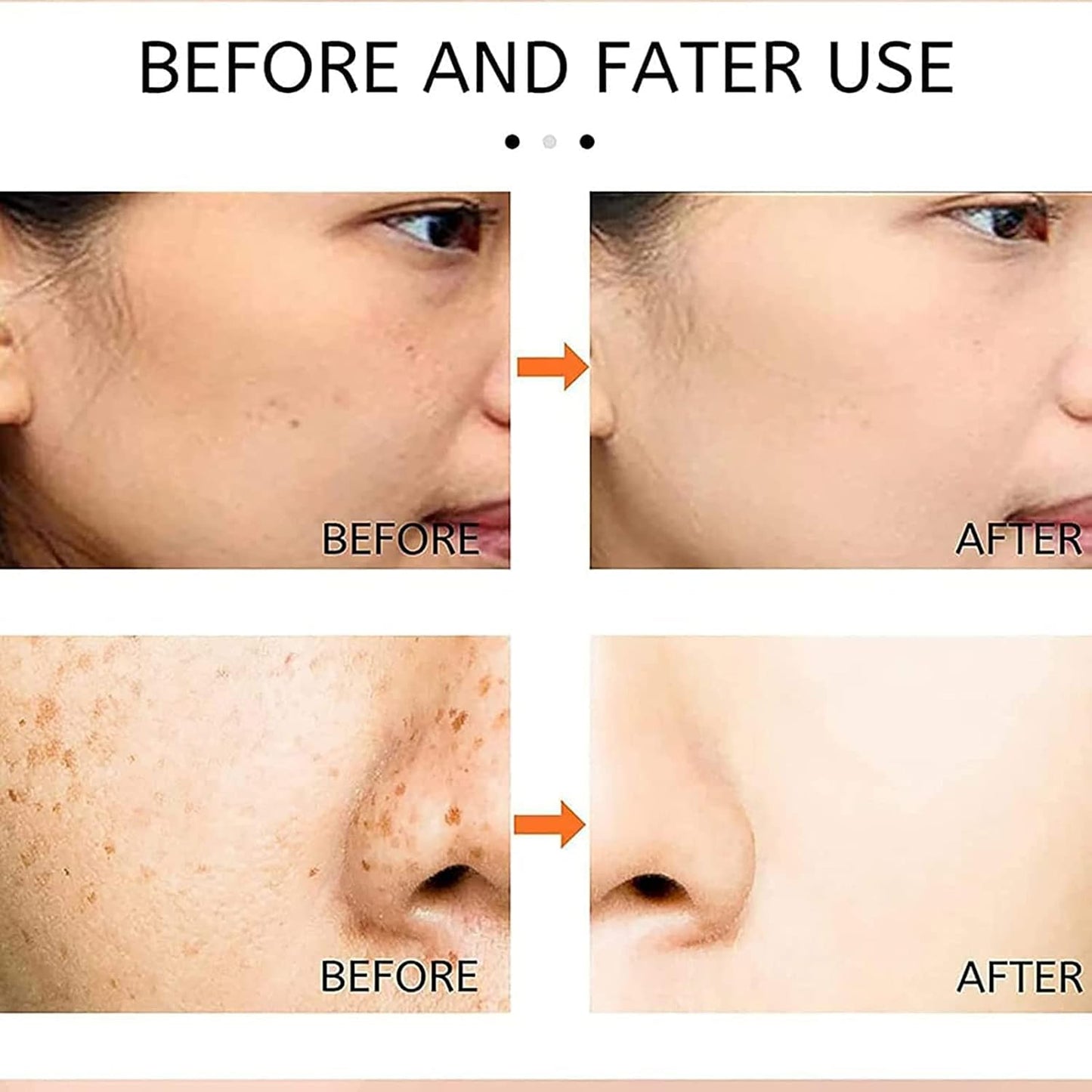 Japenese Melasma Cream: