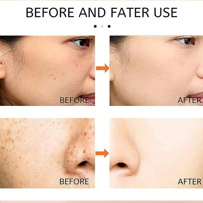 Japenese Melasma Cream:
